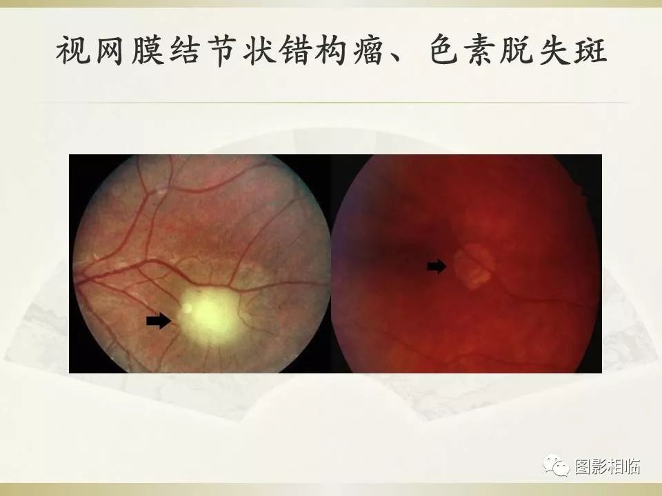 影像PPT - 【PPT】TSC临床及影像表现-21