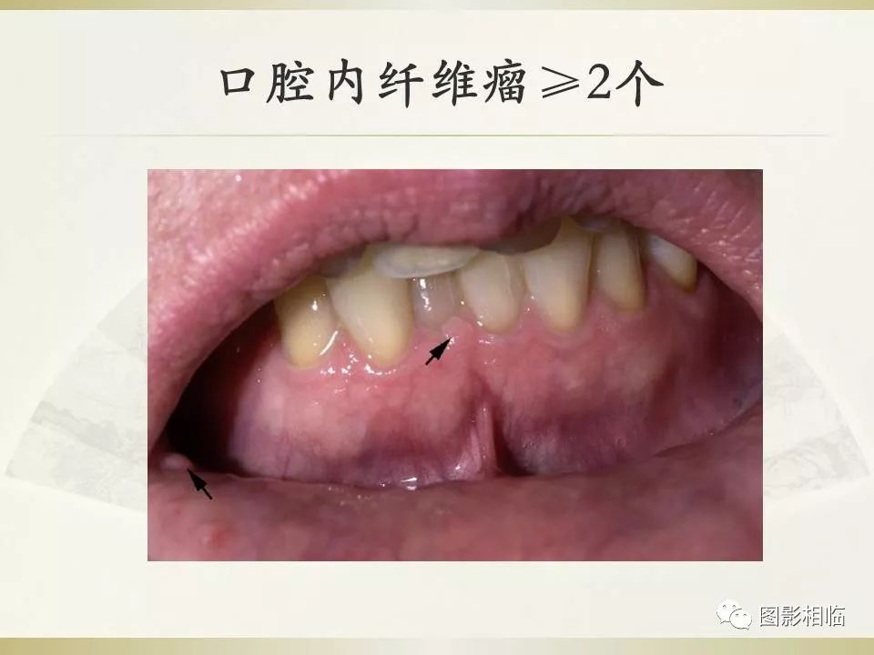 影像PPT - 【PPT】TSC临床及影像表现-20