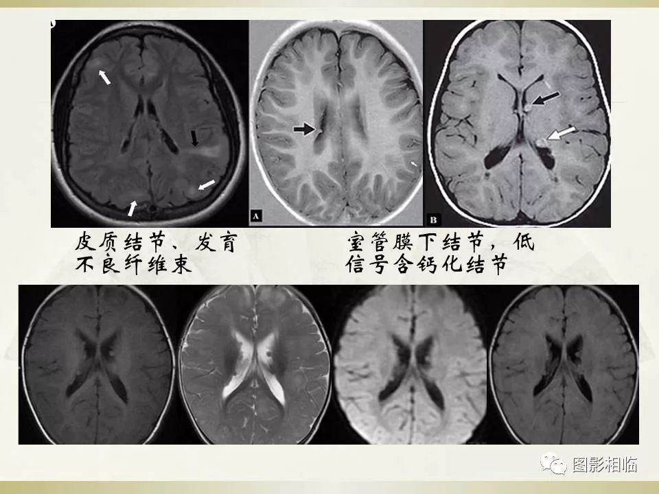 影像PPT - 【PPT】TSC临床及影像表现-26