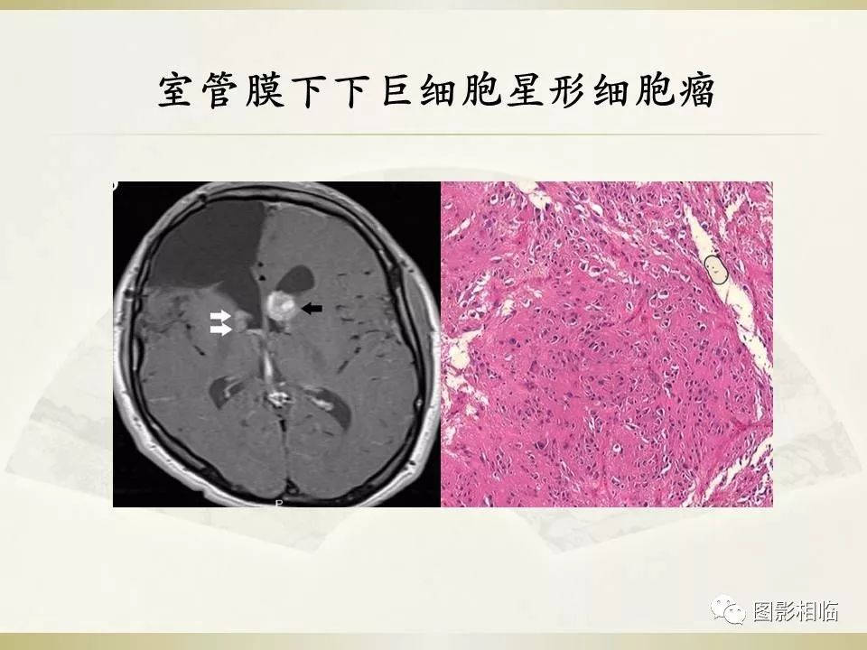 影像PPT - 【PPT】TSC临床及影像表现-27