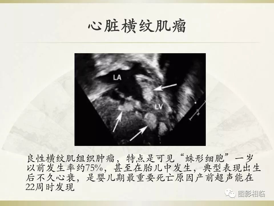 影像PPT - 【PPT】TSC临床及影像表现-28