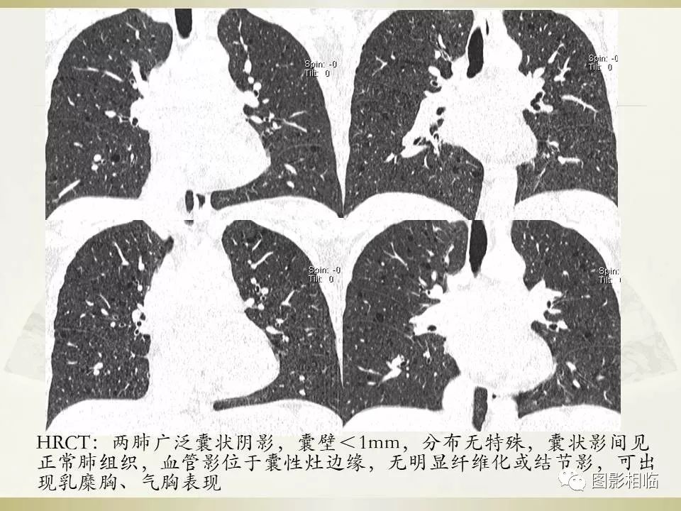影像PPT - 【PPT】TSC临床及影像表现-30