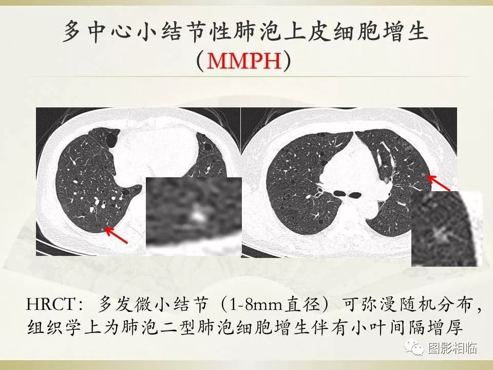 影像PPT - 【PPT】TSC临床及影像表现-31