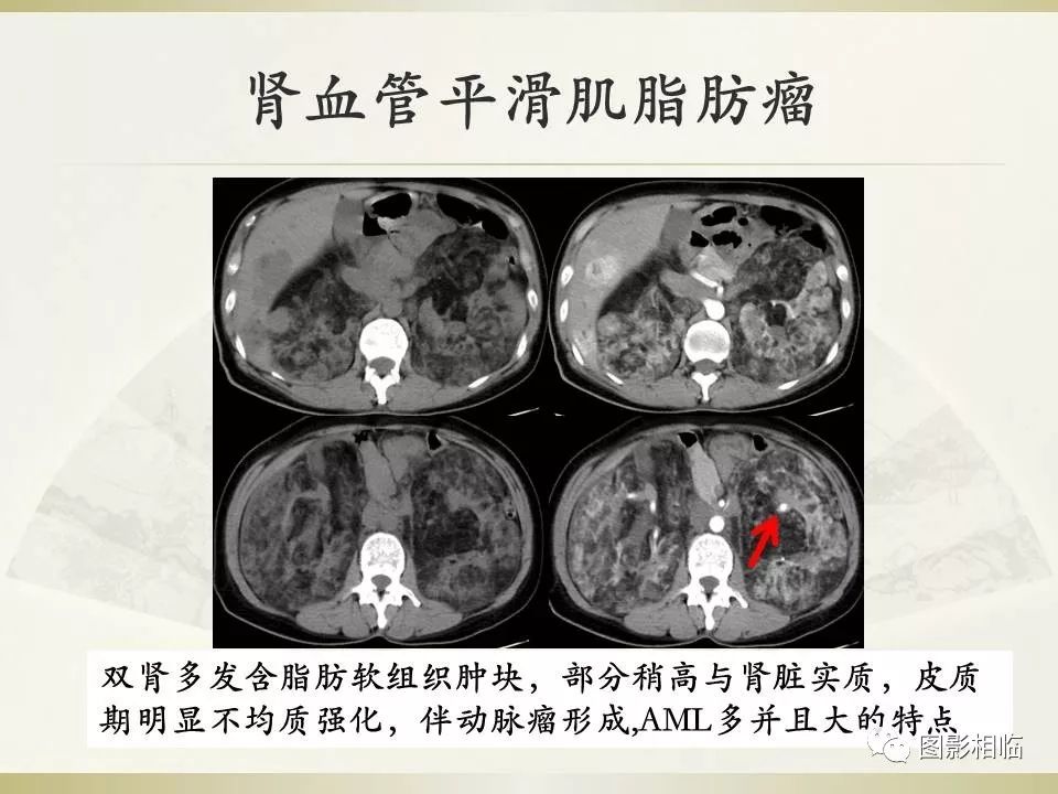 影像PPT - 【PPT】TSC临床及影像表现-32