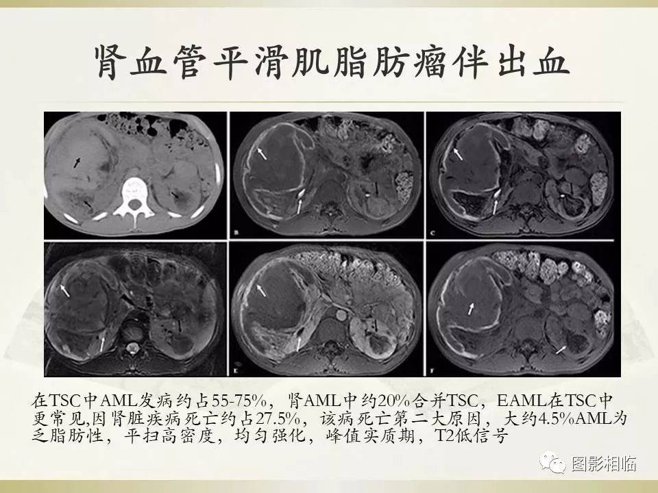 影像PPT - 【PPT】TSC临床及影像表现-33