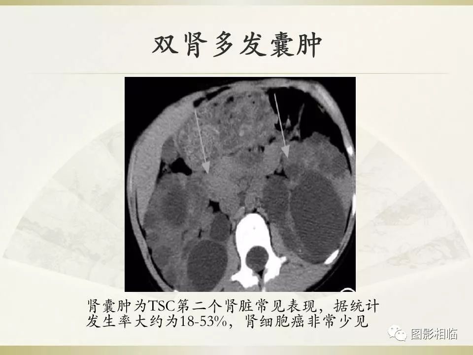 影像PPT - 【PPT】TSC临床及影像表现-34