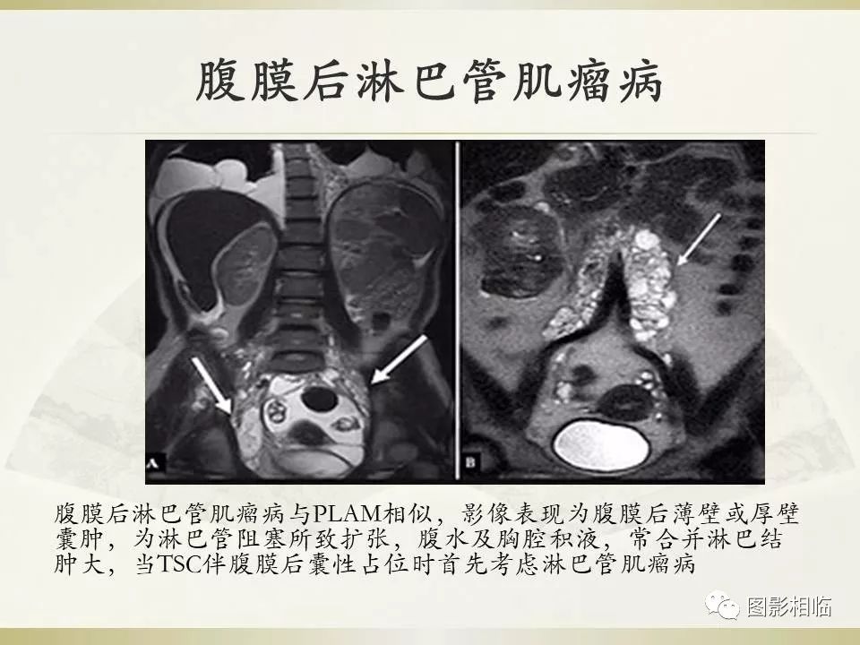 影像PPT - 【PPT】TSC临床及影像表现-35
