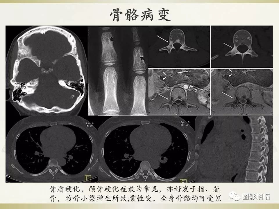 影像PPT - 【PPT】TSC临床及影像表现-36
