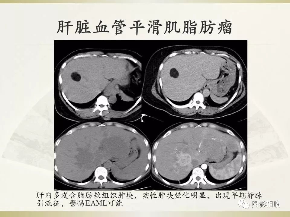 影像PPT - 【PPT】TSC临床及影像表现-37