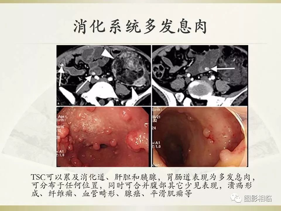 影像PPT - 【PPT】TSC临床及影像表现-38