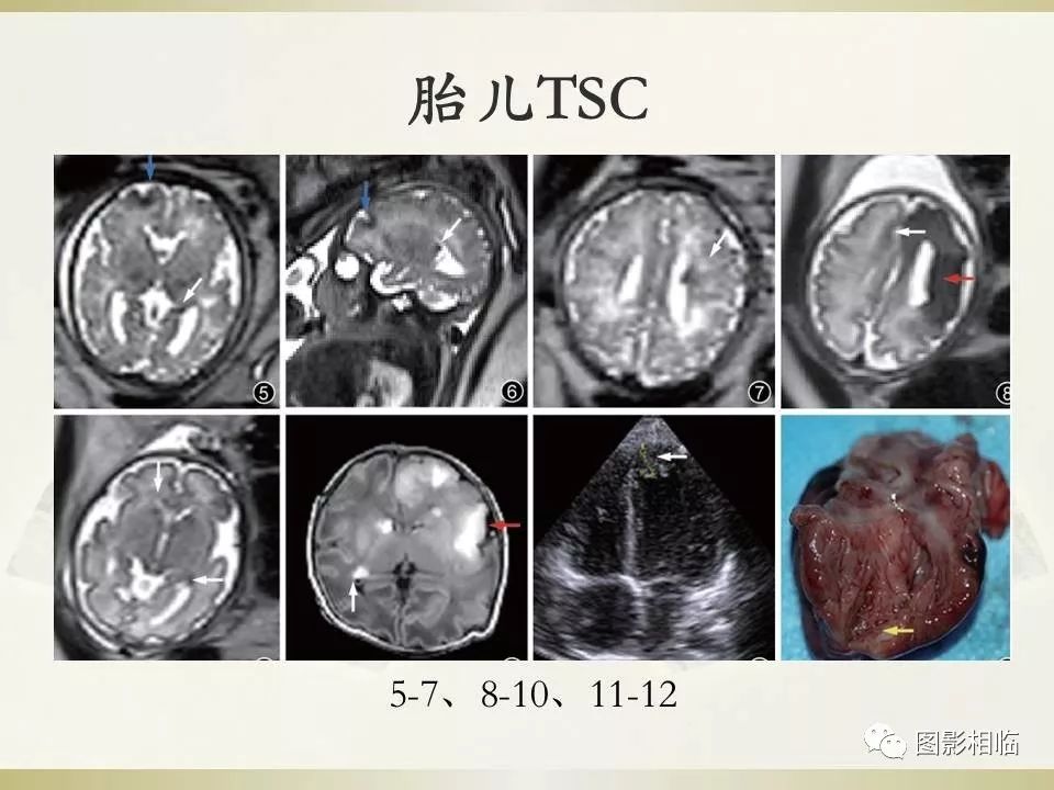 影像PPT - 【PPT】TSC临床及影像表现-39