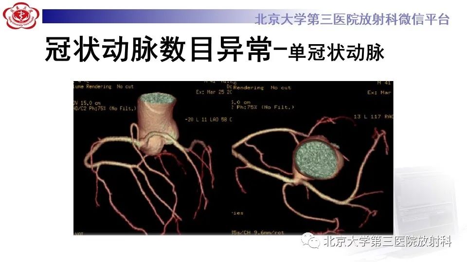 影像PPT - 【PPT】冠状动脉解剖异常-13