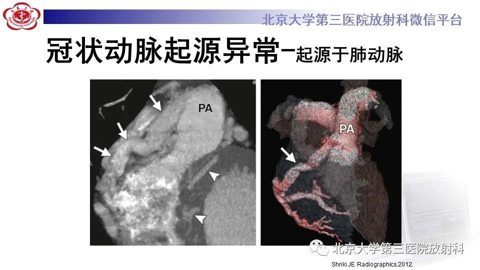 影像PPT - 【PPT】冠状动脉解剖异常-21