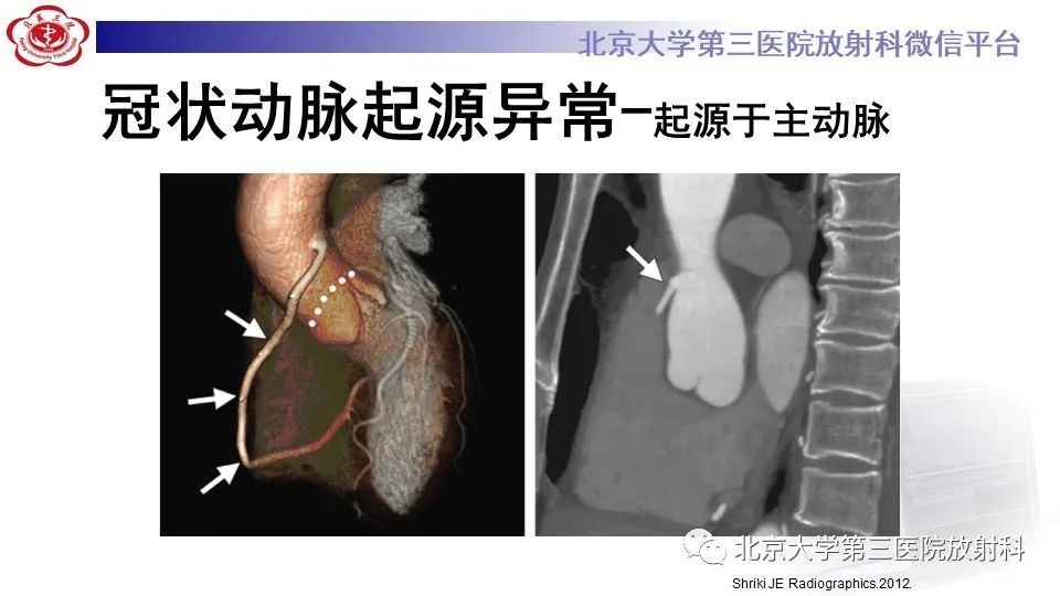 影像PPT - 【PPT】冠状动脉解剖异常-23