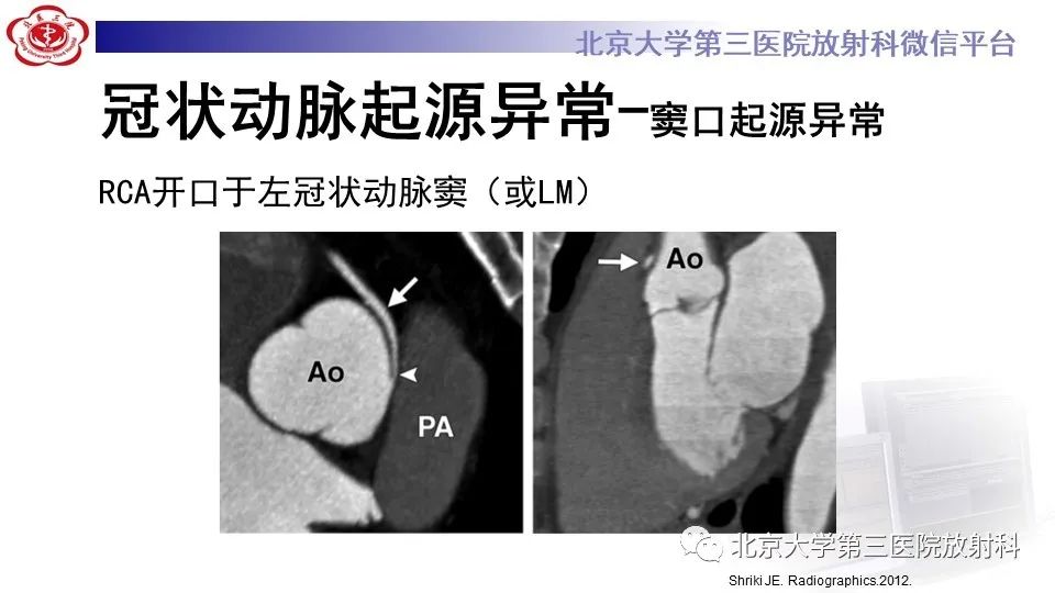 影像PPT - 【PPT】冠状动脉解剖异常-30