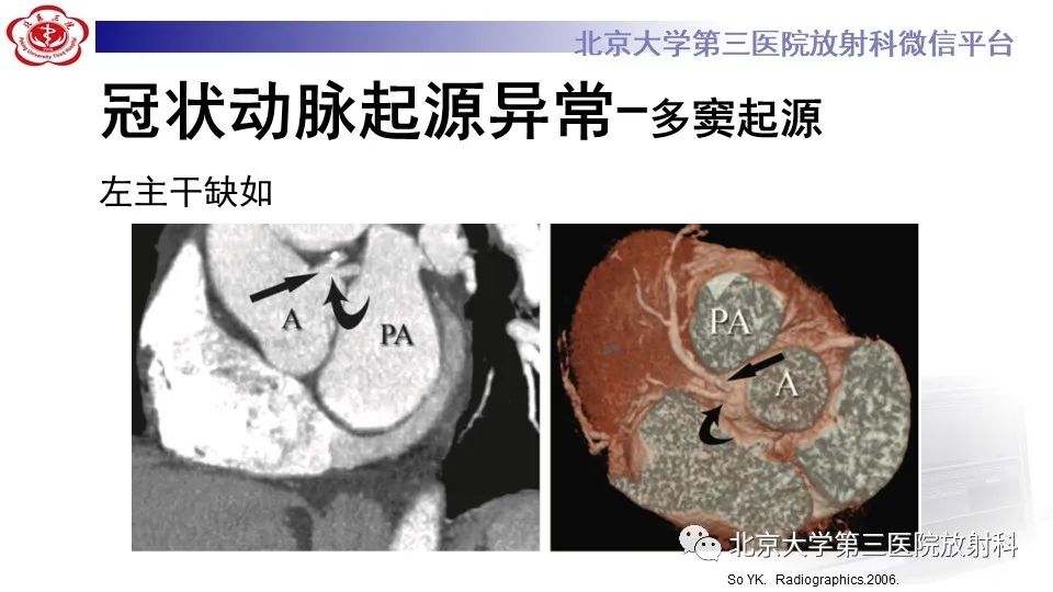 影像PPT - 【PPT】冠状动脉解剖异常-33
