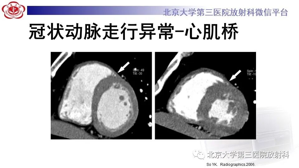 影像PPT - 【PPT】冠状动脉解剖异常-38