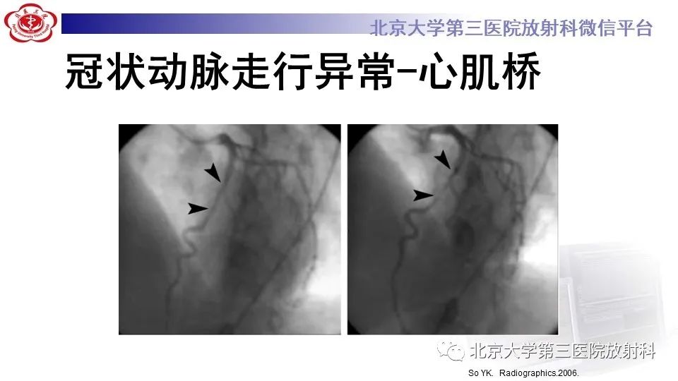 影像PPT - 【PPT】冠状动脉解剖异常-39