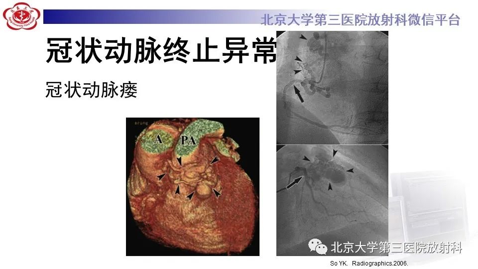 影像PPT - 【PPT】冠状动脉解剖异常-43
