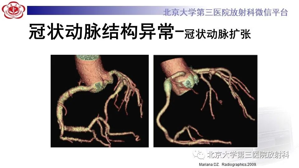 影像PPT - 【PPT】冠状动脉解剖异常-50