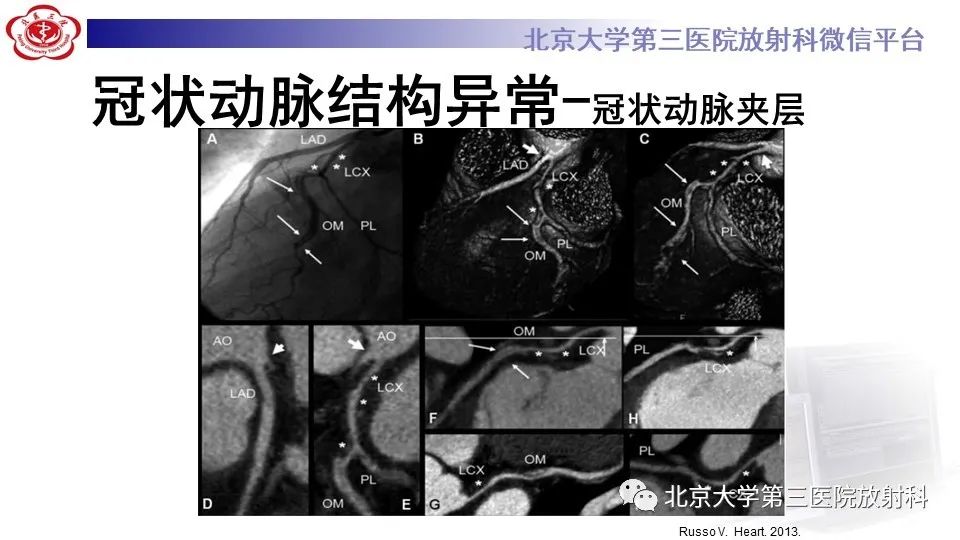 影像PPT - 【PPT】冠状动脉解剖异常-52