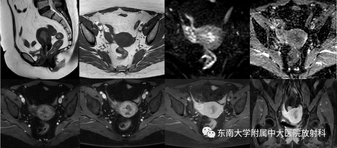 影像PPT - 【PPT】子宫内膜癌-5 影像PPT - 【PPT】子宫内膜癌-5