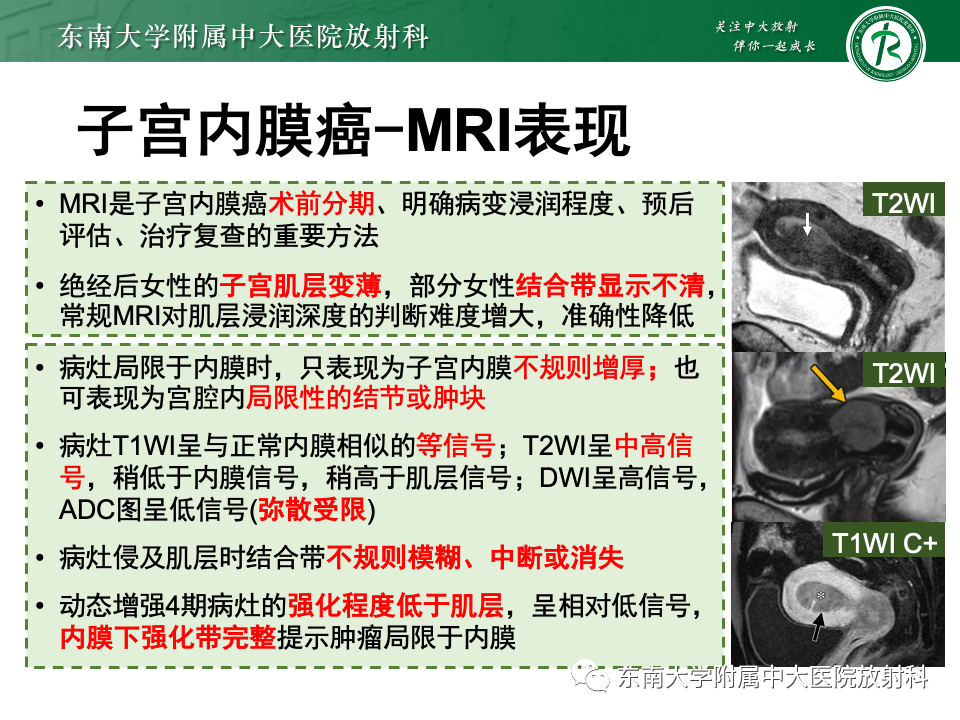 影像PPT - 【PPT】子宫内膜癌-21 影像PPT - 【PPT】子宫内膜癌-21