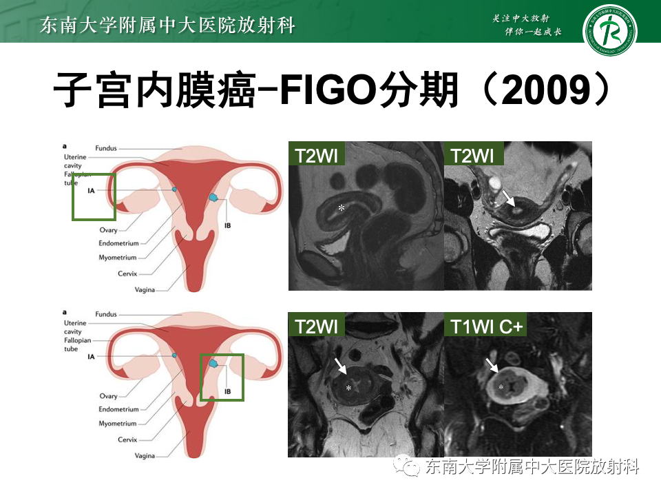 影像PPT - 【PPT】子宫内膜癌-23 影像PPT - 【PPT】子宫内膜癌-23