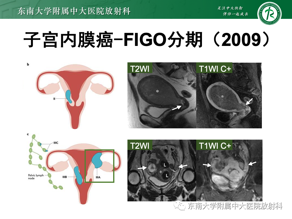 影像PPT - 【PPT】子宫内膜癌-24 影像PPT - 【PPT】子宫内膜癌-24