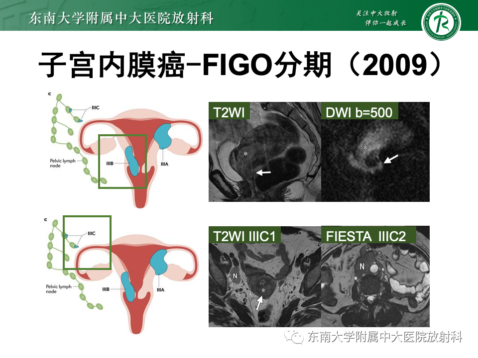 影像PPT - 【PPT】子宫内膜癌-25 影像PPT - 【PPT】子宫内膜癌-25