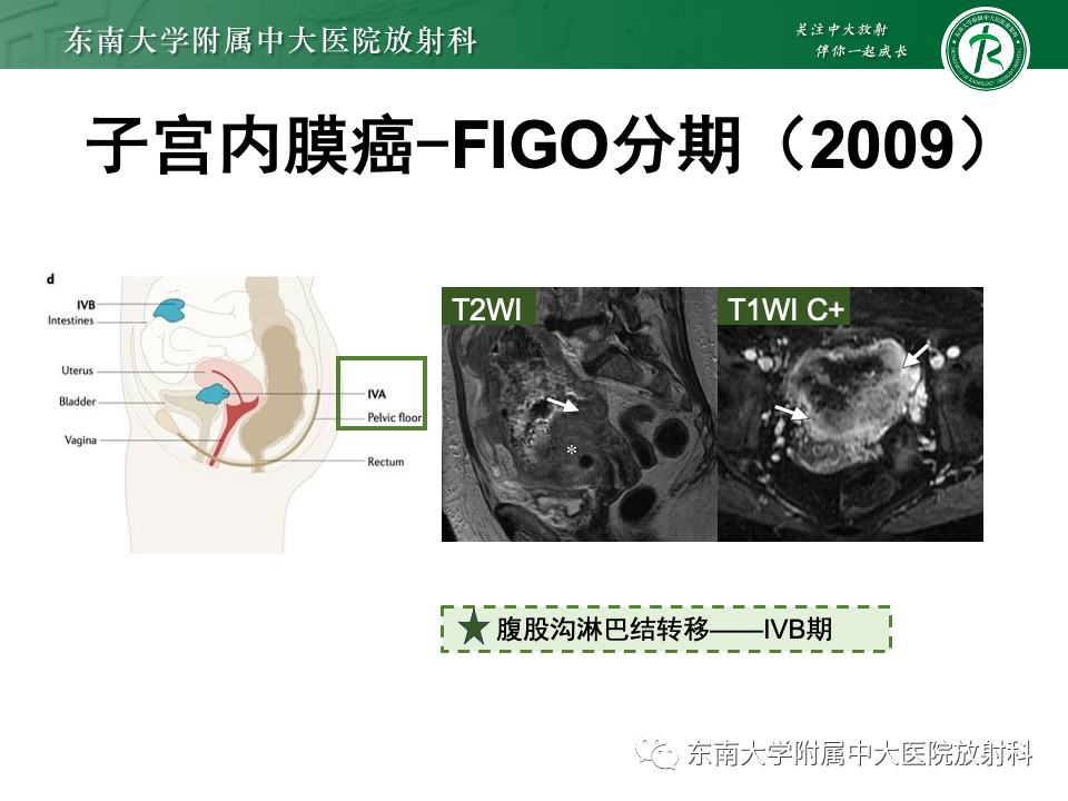 影像PPT - 【PPT】子宫内膜癌-26 影像PPT - 【PPT】子宫内膜癌-26