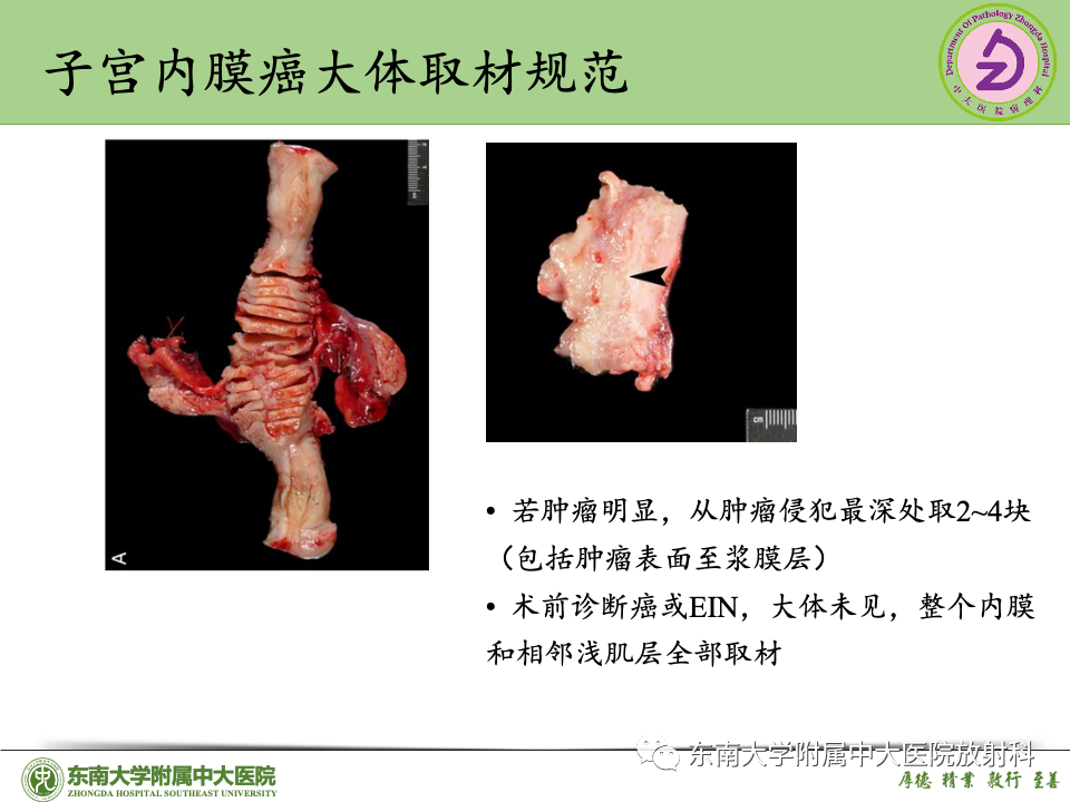 影像PPT - 【PPT】子宫内膜癌-31 影像PPT - 【PPT】子宫内膜癌-31