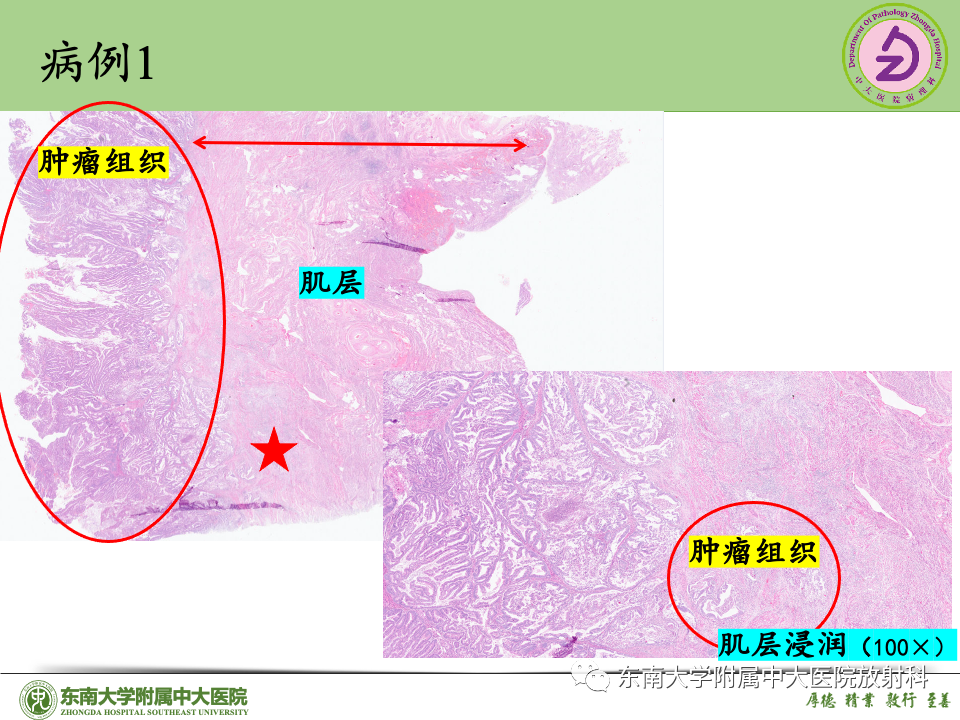 影像PPT - 【PPT】子宫内膜癌-32 影像PPT - 【PPT】子宫内膜癌-32