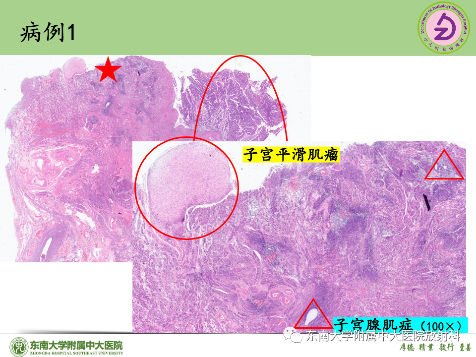 影像PPT - 【PPT】子宫内膜癌-33 影像PPT - 【PPT】子宫内膜癌-33