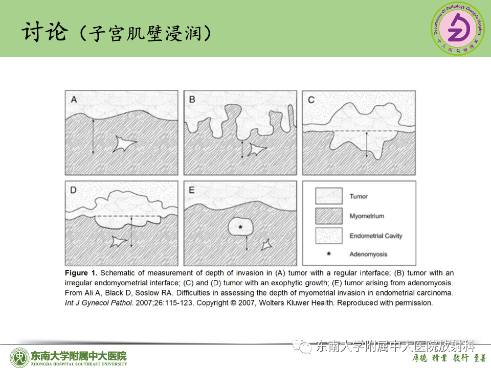 影像PPT - 【PPT】子宫内膜癌-34 影像PPT - 【PPT】子宫内膜癌-34