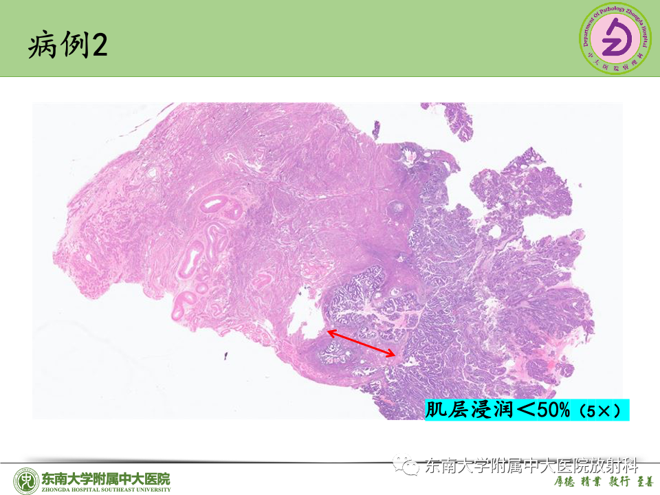 影像PPT - 【PPT】子宫内膜癌-35 影像PPT - 【PPT】子宫内膜癌-35