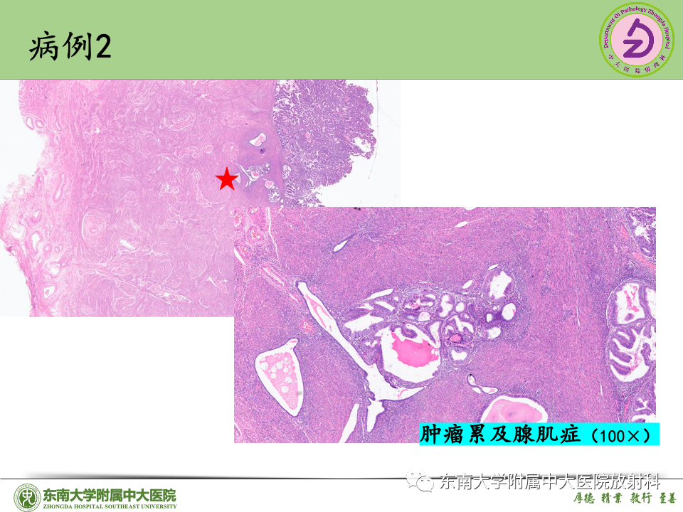 影像PPT - 【PPT】子宫内膜癌-36 影像PPT - 【PPT】子宫内膜癌-36