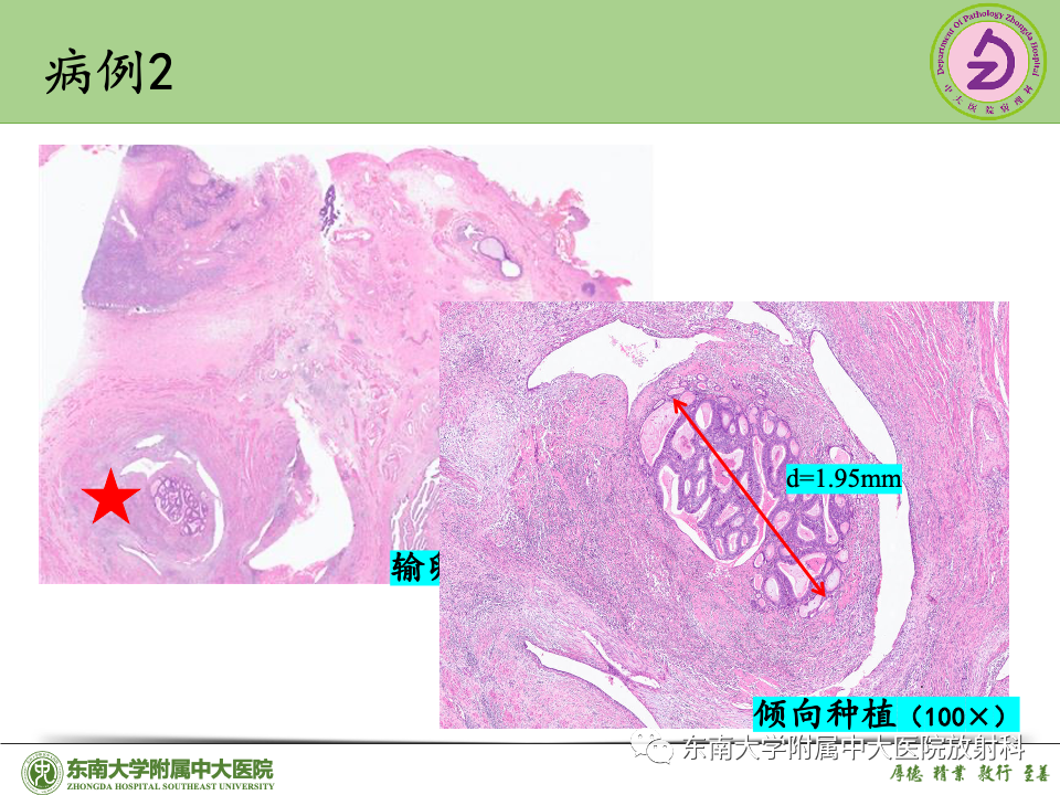 影像PPT - 【PPT】子宫内膜癌-37 影像PPT - 【PPT】子宫内膜癌-37