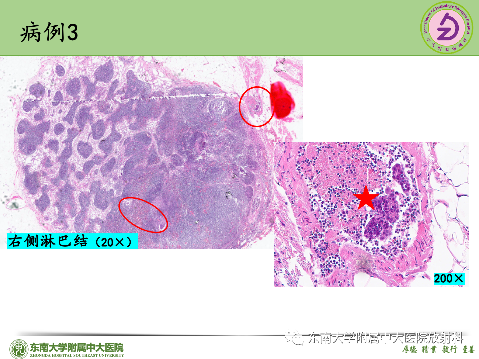 影像PPT - 【PPT】子宫内膜癌-40 影像PPT - 【PPT】子宫内膜癌-40