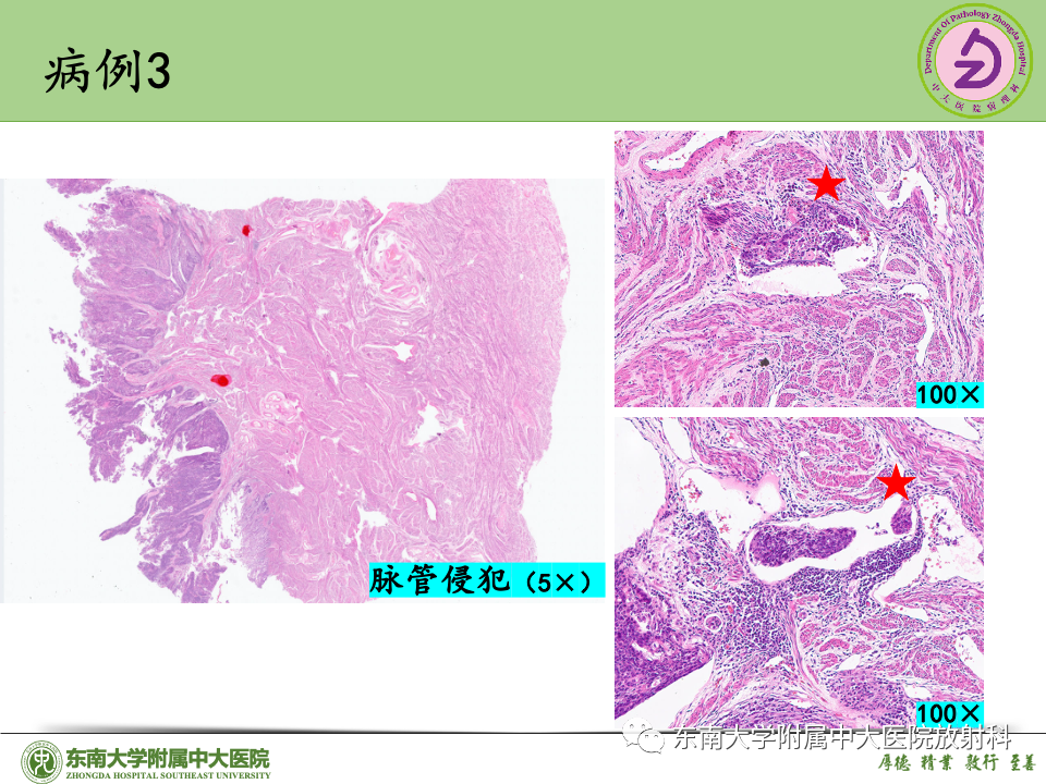 影像PPT - 【PPT】子宫内膜癌-39 影像PPT - 【PPT】子宫内膜癌-39