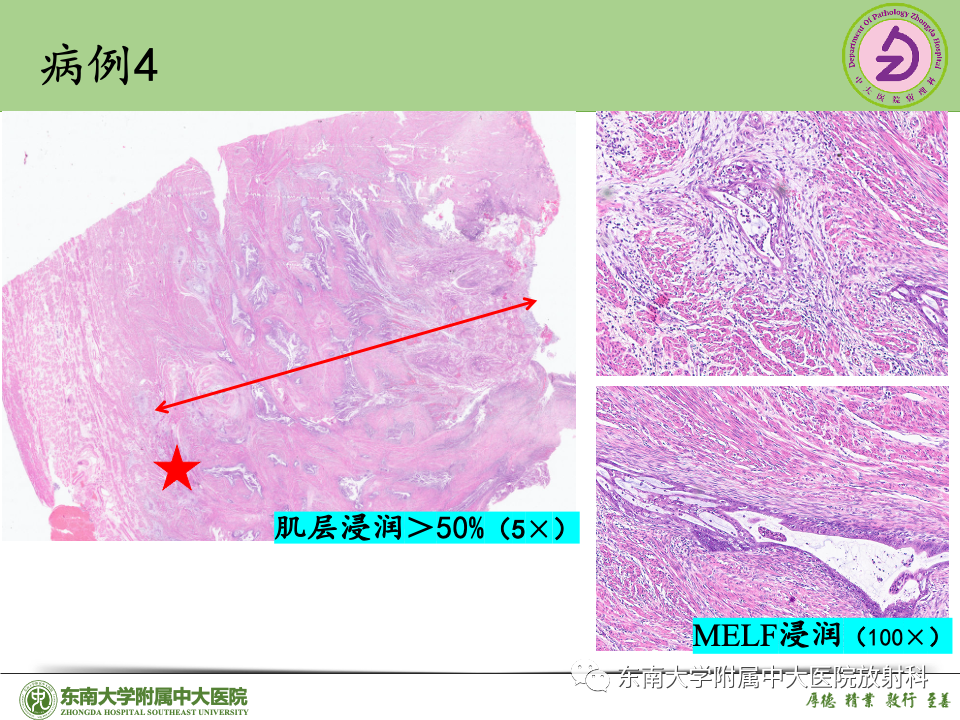 影像PPT - 【PPT】子宫内膜癌-43 影像PPT - 【PPT】子宫内膜癌-43