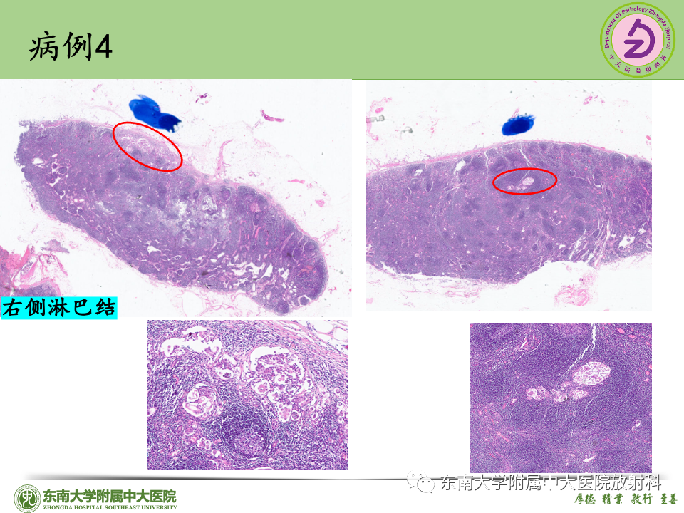 影像PPT - 【PPT】子宫内膜癌-45 影像PPT - 【PPT】子宫内膜癌-45