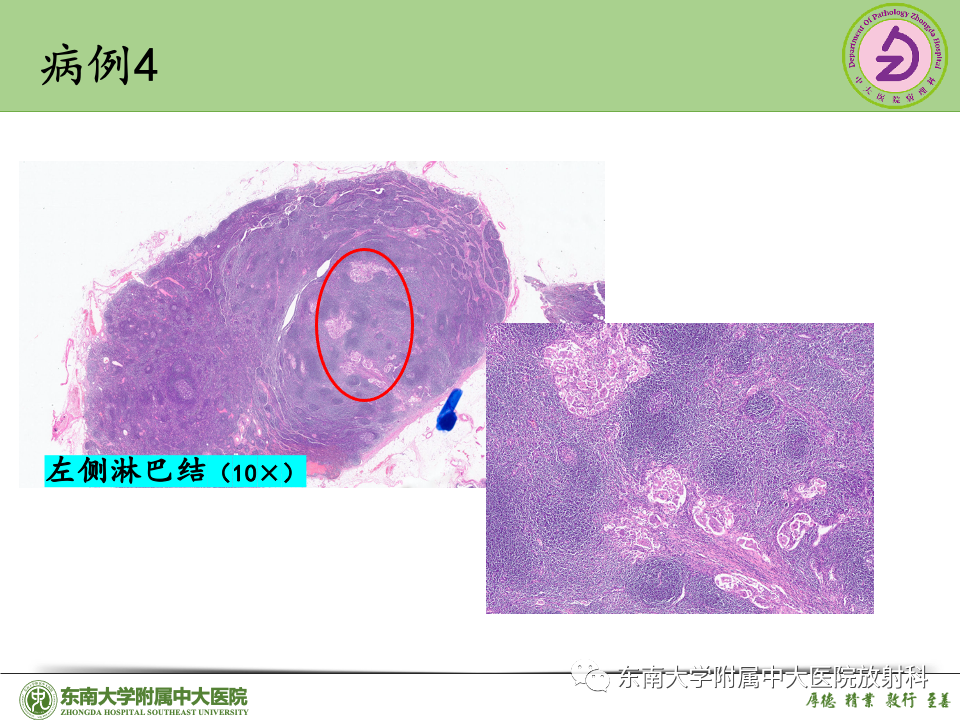 影像PPT - 【PPT】子宫内膜癌-46 影像PPT - 【PPT】子宫内膜癌-46