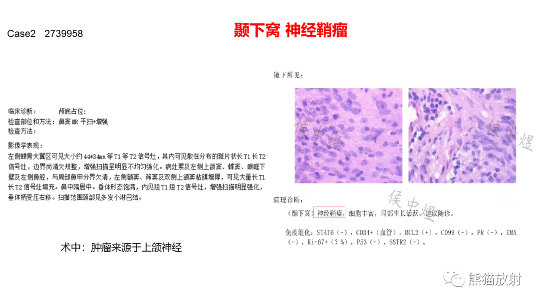 影像PPT - 【病例】鼻咽纤维血管瘤 VS 神经鞘瘤-12