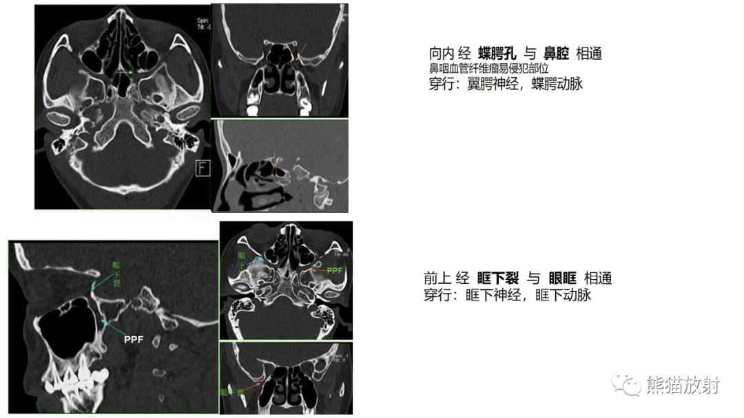 影像PPT - 【病例】鼻咽纤维血管瘤 VS 神经鞘瘤-14