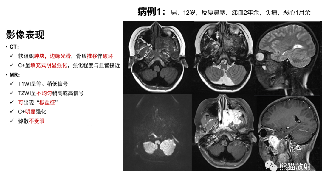 影像PPT - 【病例】鼻咽纤维血管瘤 VS 神经鞘瘤-21