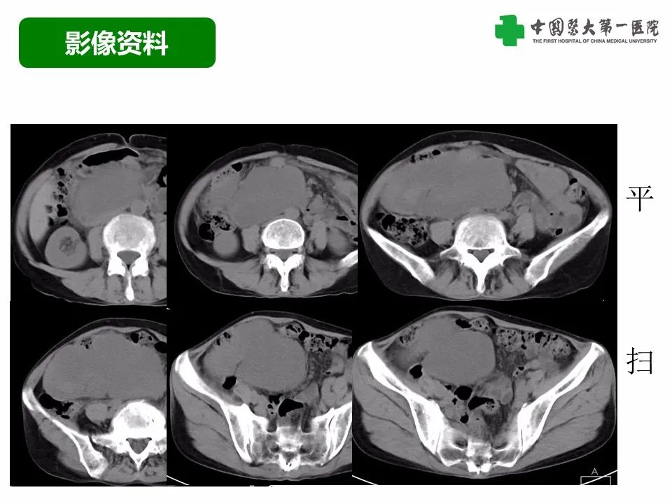 影像PPT - 【病例】腹腔韧带样纤维瘤病1例CT影像-4