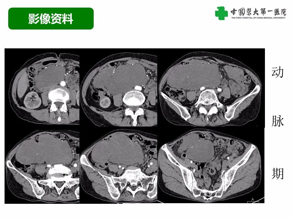 影像PPT - 【病例】腹腔韧带样纤维瘤病1例CT影像-5