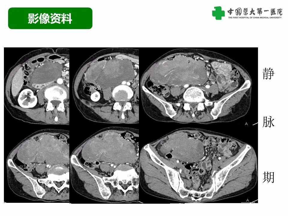 影像PPT - 【病例】腹腔韧带样纤维瘤病1例CT影像-6