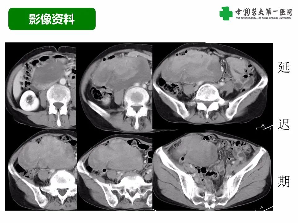 影像PPT - 【病例】腹腔韧带样纤维瘤病1例CT影像-7
